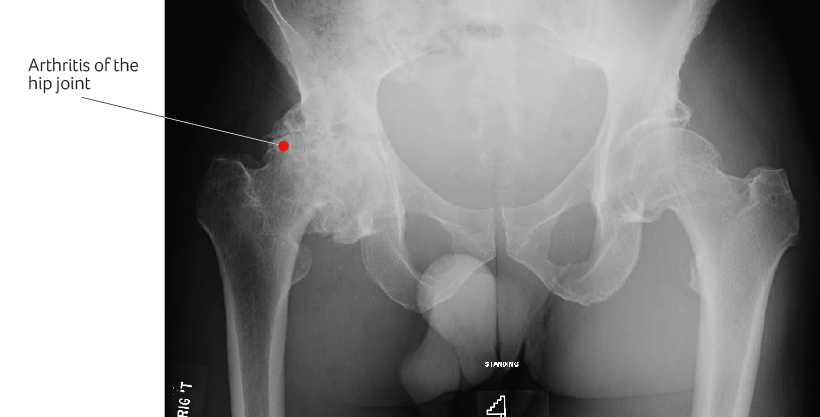 Common symptoms of hip osteoarthritis - Sports Surgery Clinic