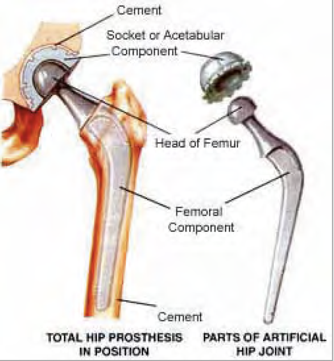 osteoarthritis hip replacement