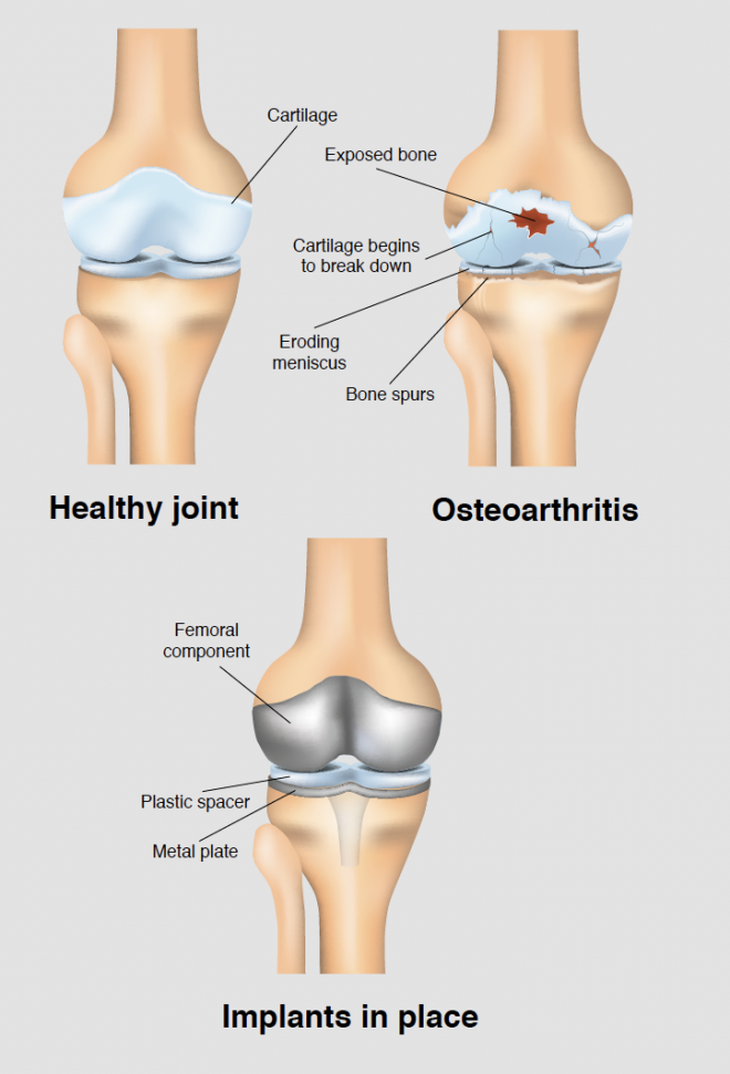 Pillow of Total knee replacement, X-ray - Media Storehouse