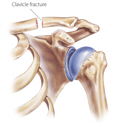 Clavicle fracture SSC