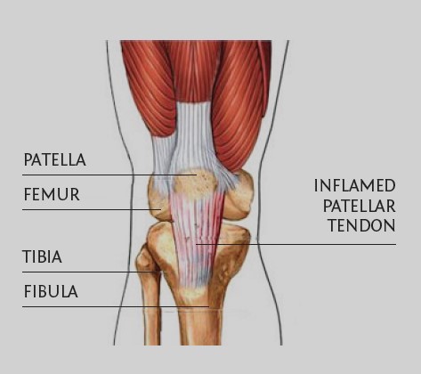 Patellar Tendinopathy Causes Diagnoses And Treatment