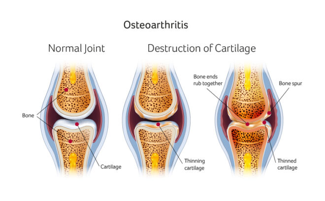 Knee Problems And Treatments Cartilage Upmc Sports Surgery Clinic