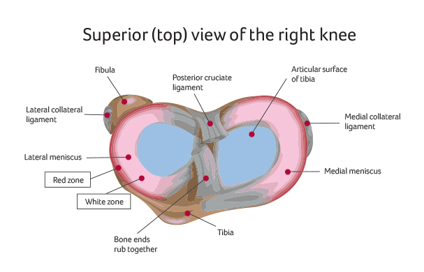 Osteoarthritis Knee Replacement Santry