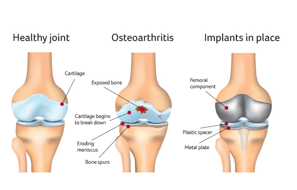 Osteoarthritis in knee