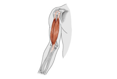 Distal Biceps tendon rupture 