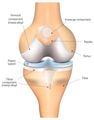 Knee Osteoarthritis Knee Surgery