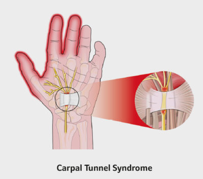 Hand and wrist Surgery - Causes and Treatments SSC